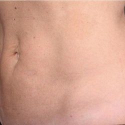 TruSculpt ID Before & After Patient #1563
